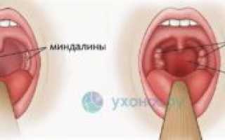 Можно ли гулять при фарингите