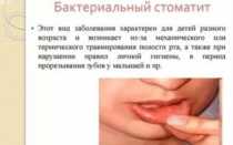 Бактериальный стоматит у детей лечение